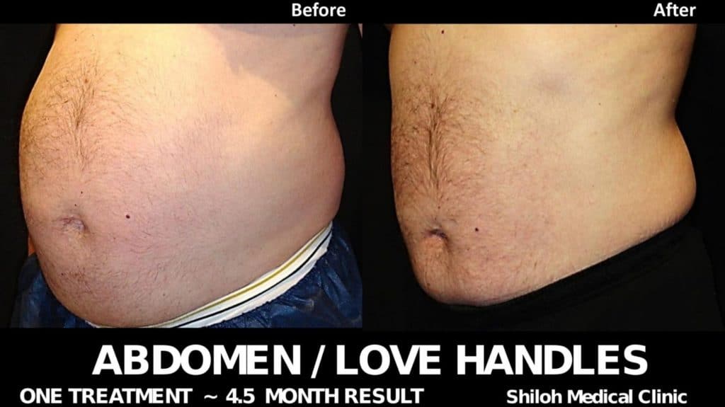 Love handles removal without surgery with CoolSculpting