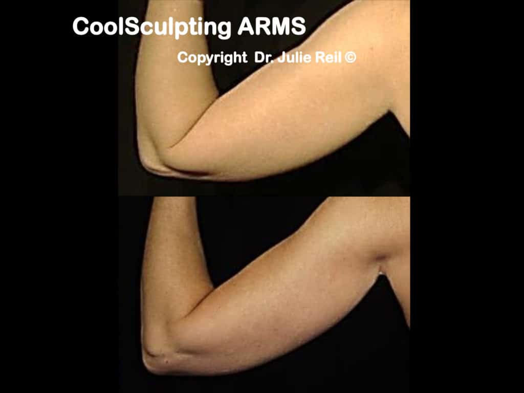CoolSculpting for Arms, Upper Arm CoolSculpting Treatment NYC - Dr