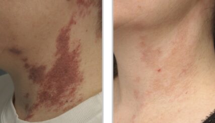 port wine stain neck