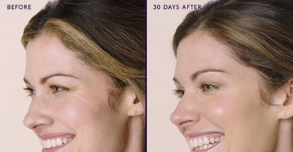 MODERATE TO SEVERE CROWS FEET 1 MODERATE TO SEVERE CROWS FEET 1