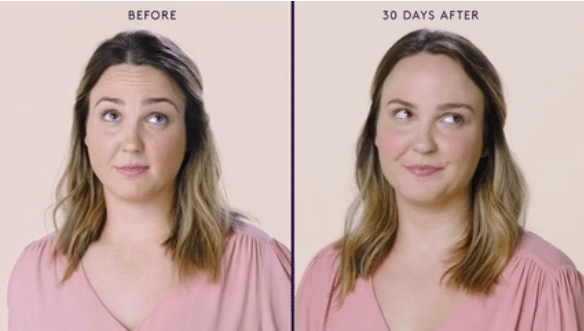 MODERATE TO SEVERE FOREHEAD LINES 2 MODERATE TO SEVERE FOREHEAD LINES 2