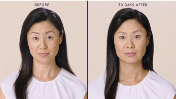 MODERATE TO SEVERE FOREHEAD LINES 4 MODERATE TO SEVERE FOREHEAD LINES 4