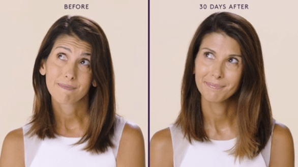 MODERATE TO SEVERE FOREHEAD LINES 5 MODERATE TO SEVERE FOREHEAD LINES 5