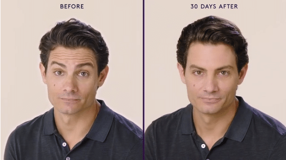 MODERATE TO SEVERE FOREHEAD LINES 6 MODERATE TO SEVERE FOREHEAD LINES 6