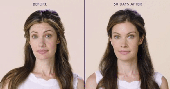 MODERATE TO SEVERE FROWN LINES 1 MODERATE TO SEVERE FROWN LINES 1