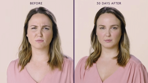 MODERATE TO SEVERE FROWN LINES 2 MODERATE TO SEVERE FROWN LINES 2