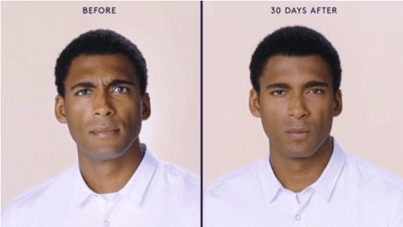 MODERATE TO SEVERE FROWN LINES 3 MODERATE TO SEVERE FROWN LINES 3