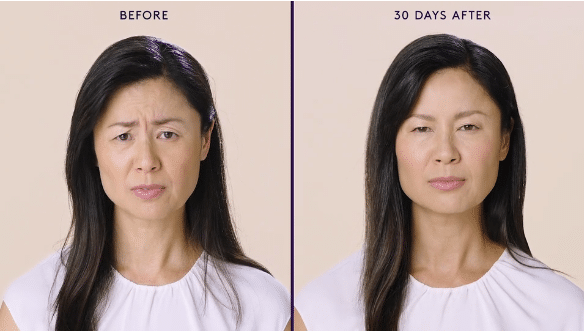 MODERATE TO SEVERE FROWN LINES 4 MODERATE TO SEVERE FROWN LINES 4