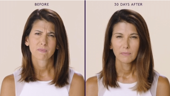 MODERATE TO SEVERE FROWN LINES 5 MODERATE TO SEVERE FROWN LINES 5