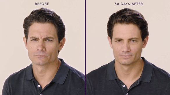 MODERATE TO SEVERE FROWN LINES 6 MODERATE TO SEVERE FROWN LINES 6