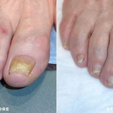 Nail fungus before and after shiloh medical