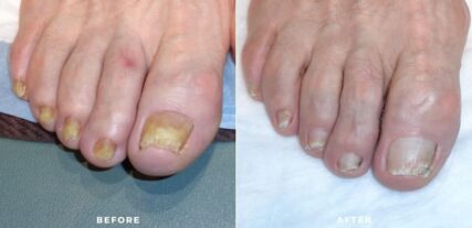 Nail fungus before and after shiloh medical