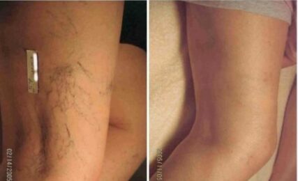 PURPLE & GREEN RETICULAR VEIN