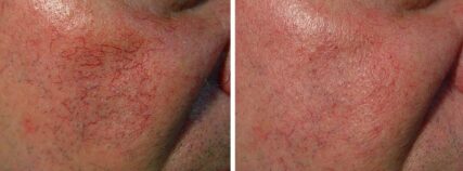SPIDER VEINS CHEEK
