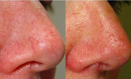 TELANGECTASIAS NOSE