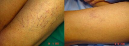 BLUE RETICULAR + SPIDER VEIN