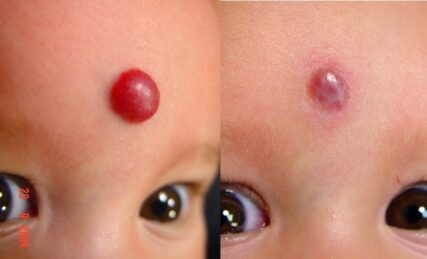 capillary hemangioma