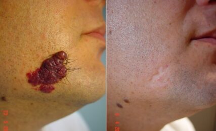 tubular vascular port wine stain