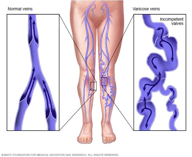 Varicose vrs Vein Image for the website