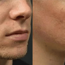 acne scars