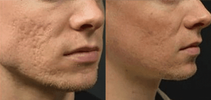 acne scars