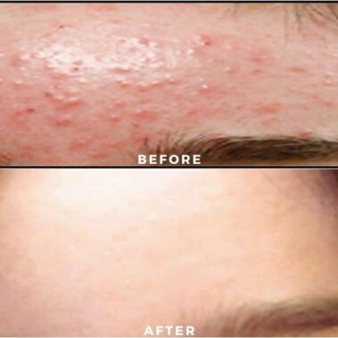 acne treatment before and after shiloh medical 1