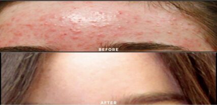 acne treatment before and after shiloh medical 1