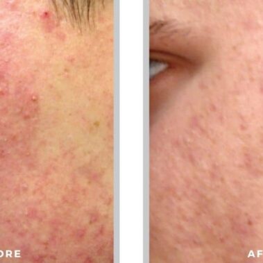 acne treatment before and after shiloh medical 2
