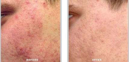 acne treatment before and after shiloh medical 2