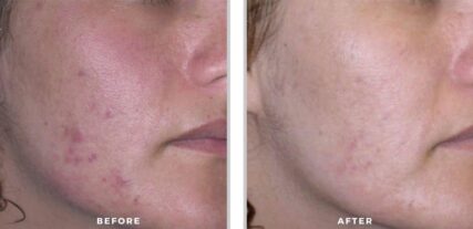 acne treatment before and after shiloh medical 3