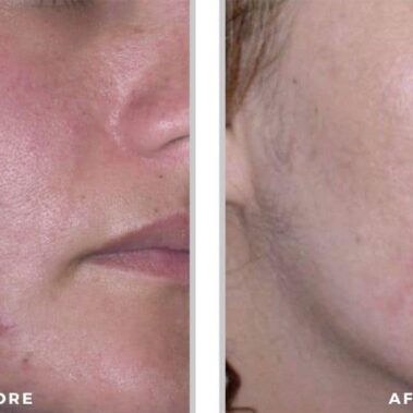 acne treatment before and after shiloh medical 3