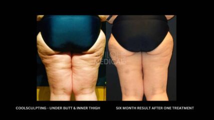 coolsculpting photos