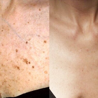 hyperpigmentation