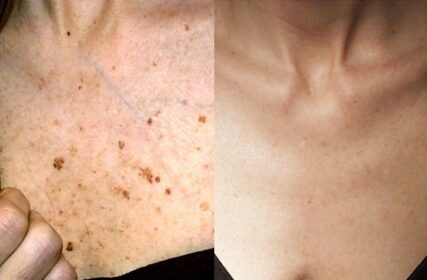 hyperpigmentation