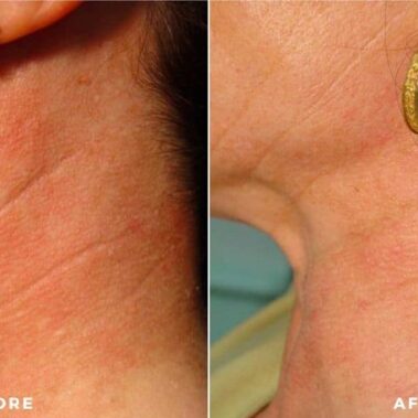 ipl bbl before and after shiloh medical 1