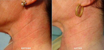 ipl bbl before and after shiloh medical 1