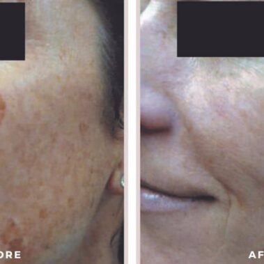 ipl bbl before and after shiloh medical 11