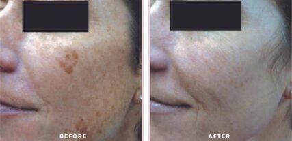 ipl bbl before and after shiloh medical 11