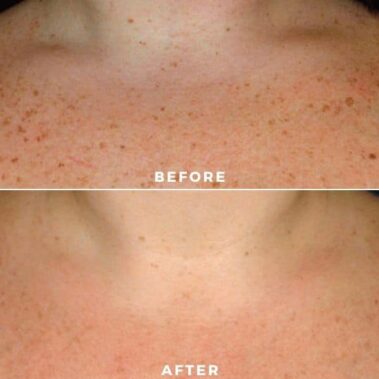 ipl bbl before and after shiloh medical 12