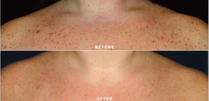 ipl bbl before and after shiloh medical 12