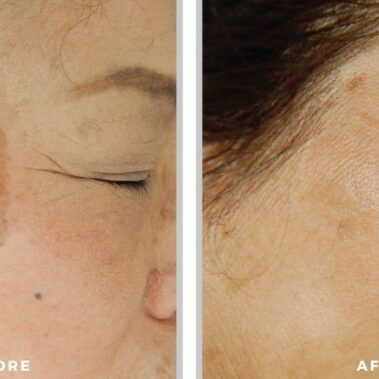 ipl bbl before and after shiloh medical 3