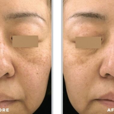 ipl bbl before and after shiloh medical 4