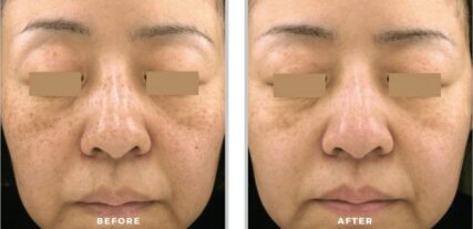 ipl bbl before and after shiloh medical 4