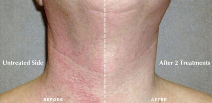 ipl bbl before and after shiloh medical 7