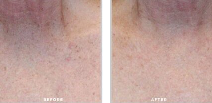 ipl bbl before and after shiloh medical 8