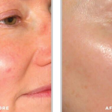 ipl bbl before and after shiloh medical 9