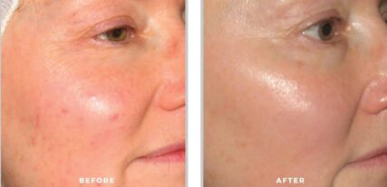 ipl bbl before and after shiloh medical 9