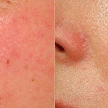 laser genesis facial before and after shilohmedical 2