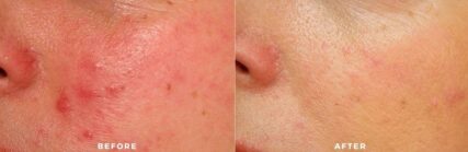 laser genesis facial before and after shilohmedical 2