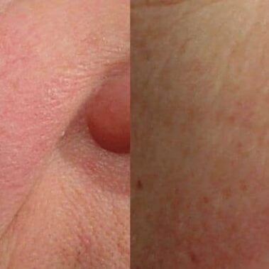 laser genesis facial before and after shilohmedical 3